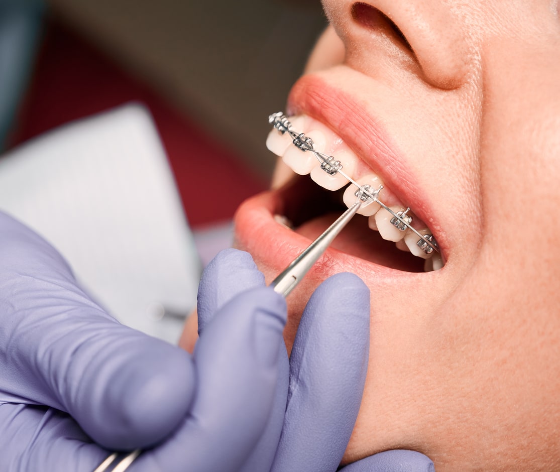 A woman is getting adults braces on her teeth.