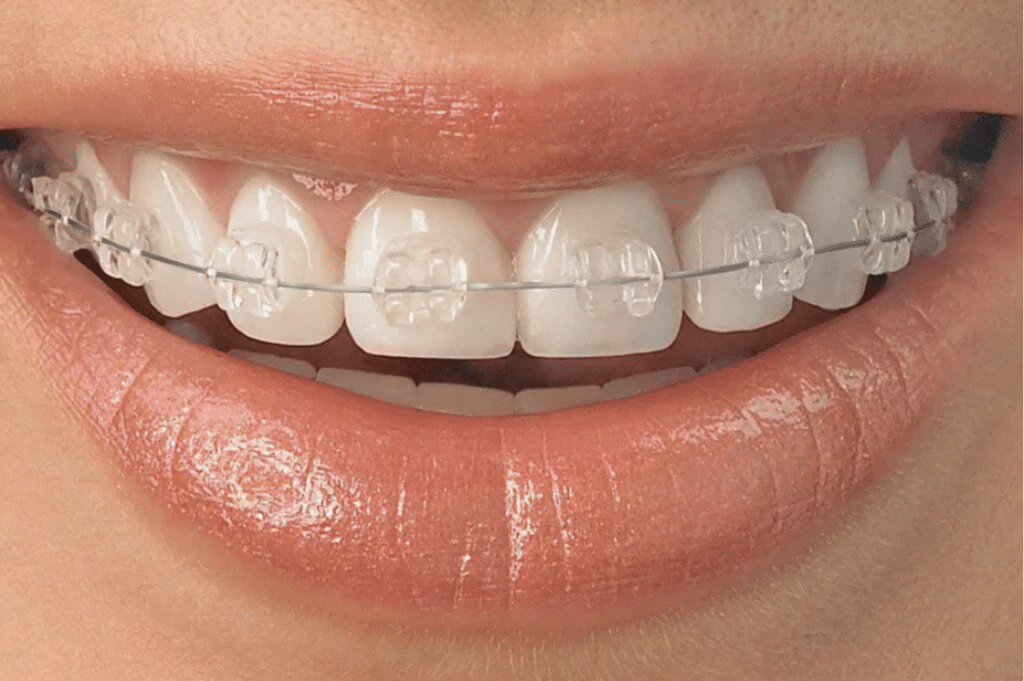 Close up of a smiling patient with sleek clear braces